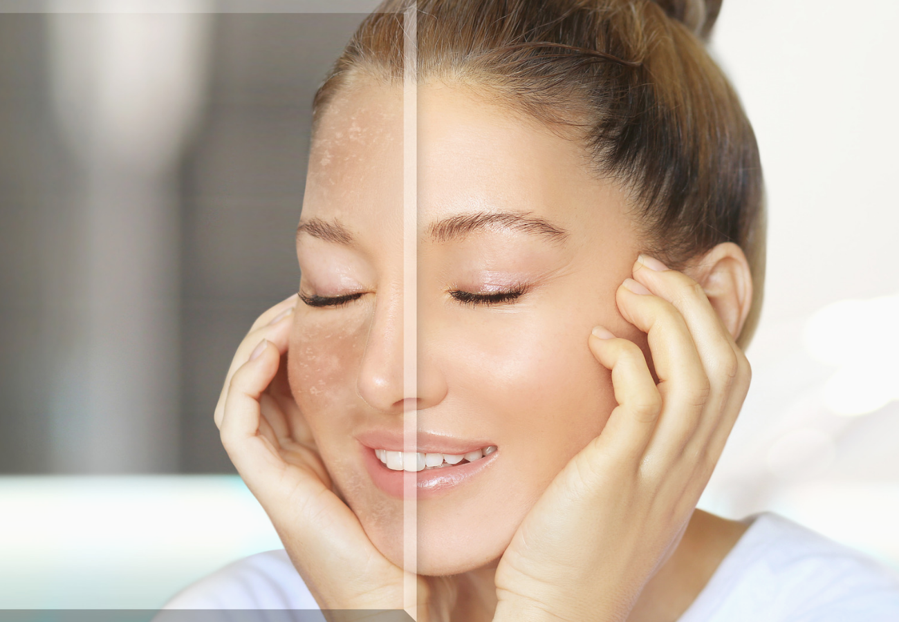 Léčba hyperpigmentace léky