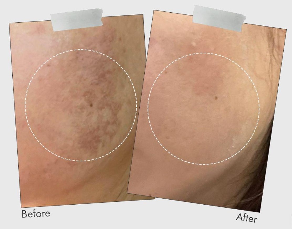 Obrázek: Neinvazivní mezoterapie IDENEL - výsledky