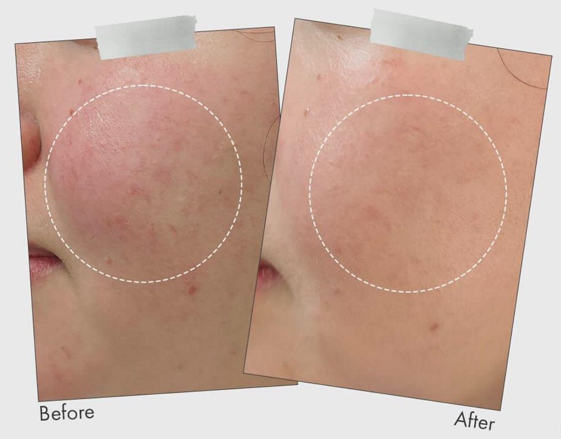 Obrázek: Výsledky ošetření Idenel